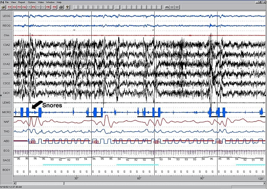 Assessment - EEG of OSA